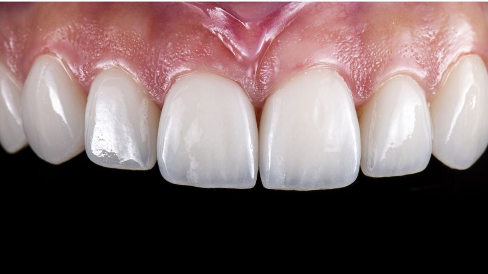 Veneers